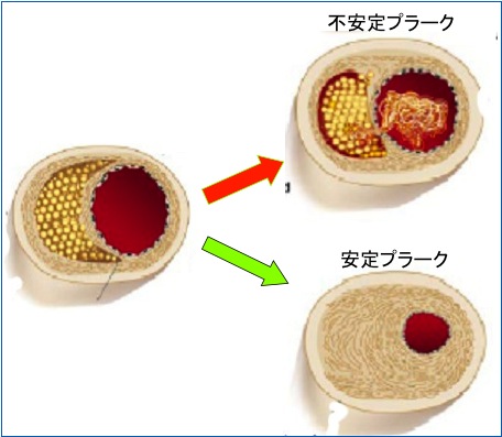 ＜参考＞不安定プラークについての図式