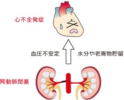 （図１）腎動脈の動脈硬化と心不全の関係