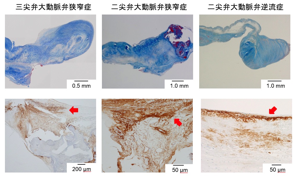二尖弁大動脈弁狭窄症の進展メカニズムについての病理学的検討 プレスリリース 広報活動 国立循環器病研究センター