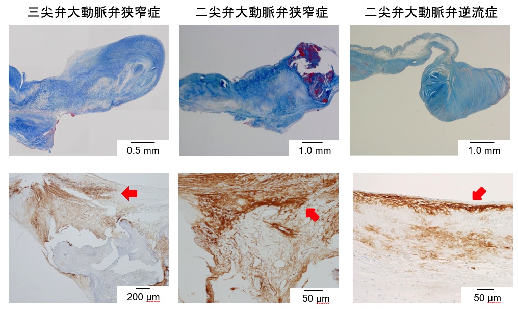 大動脈二尖弁の診断