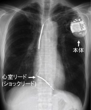 （注1）ICD（implantable cardioverter-defibrillator：植込み型除細動器）