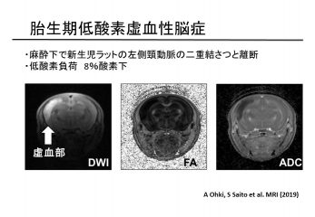 図2　胎児期低酸素脳症のMRI
