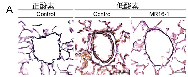 肺動脈性肺高血圧症（PAH）病態形成での炎症性サイトカインの役割解明と新しい治療法開発