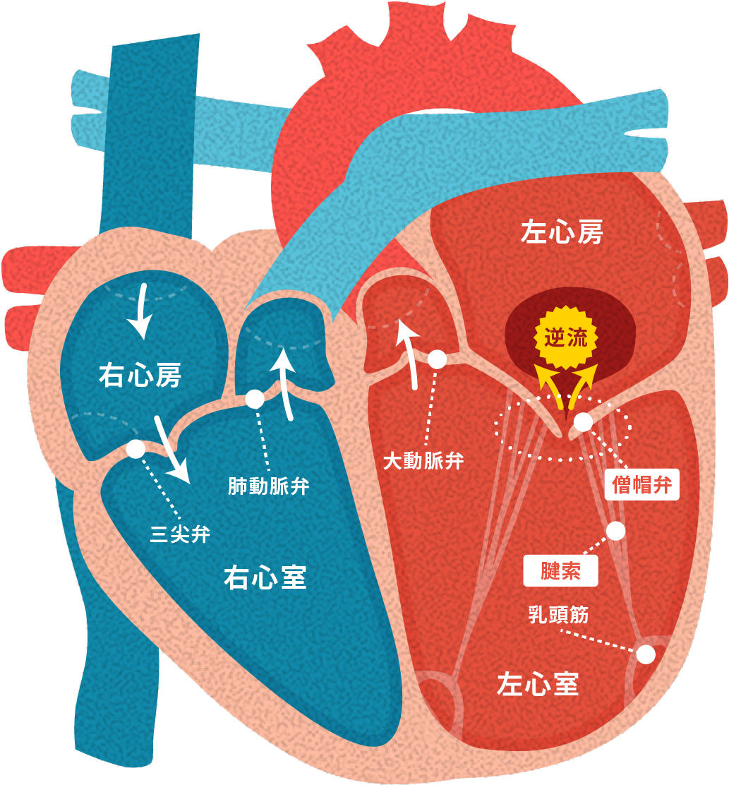 機能性（二次性）MR 図