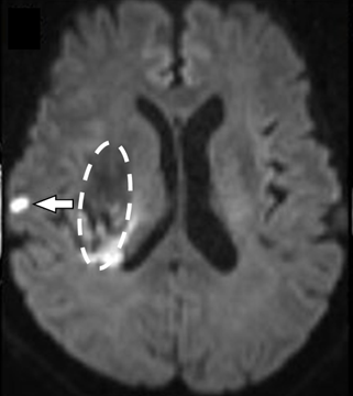 脳出血を発症した時の隠れた小さな脳梗塞