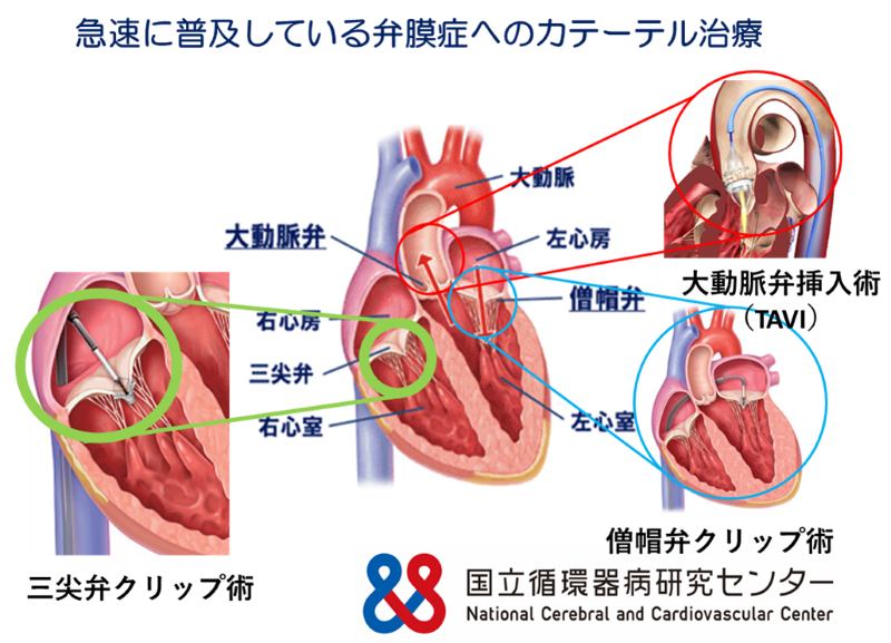 急速に普及している弁膜症へのカテーテル治療