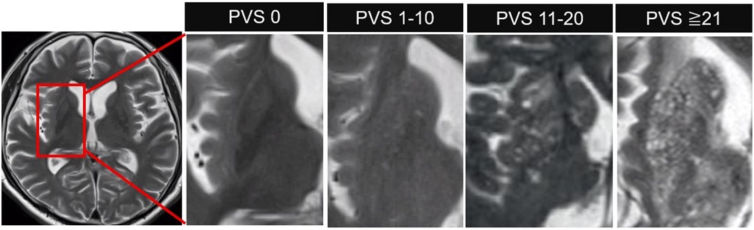 血管周囲腔拡大は脳梗塞及び重大出血の発生と関連 ―血管周囲腔拡大の臨床的影響を解明― ～２年の研究調査から得た血管リスク評価指標～